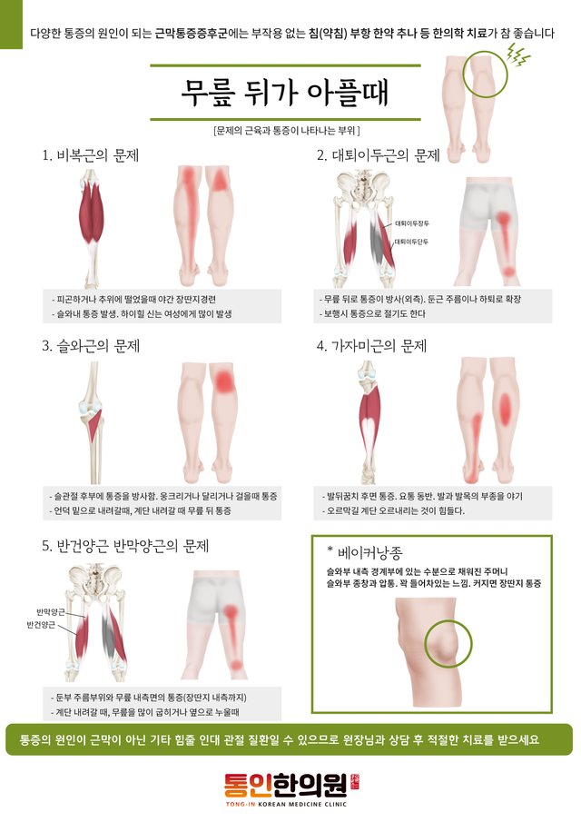 [근막통증증후군9]무릎뒤가 아플때(a4).jpg